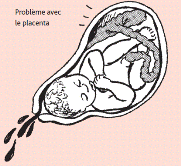 Problème avec le placenta. Illustration: Hesperian Health Guides