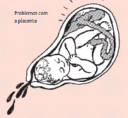Problemas com a placenta. Ilustração: Hesperian Health Guides