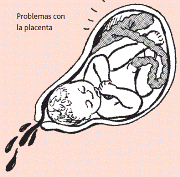 Problemas con la placenta. Ilustraciones: Hesperian Health Guides