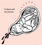 Problems with the placenta. Illustration: Hesperian Health Guides